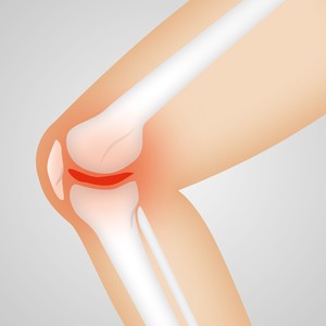Arthrose